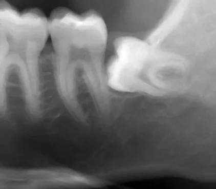 An example dental X-ray showing a horizontally positioned wisdom tooth beside a molar.