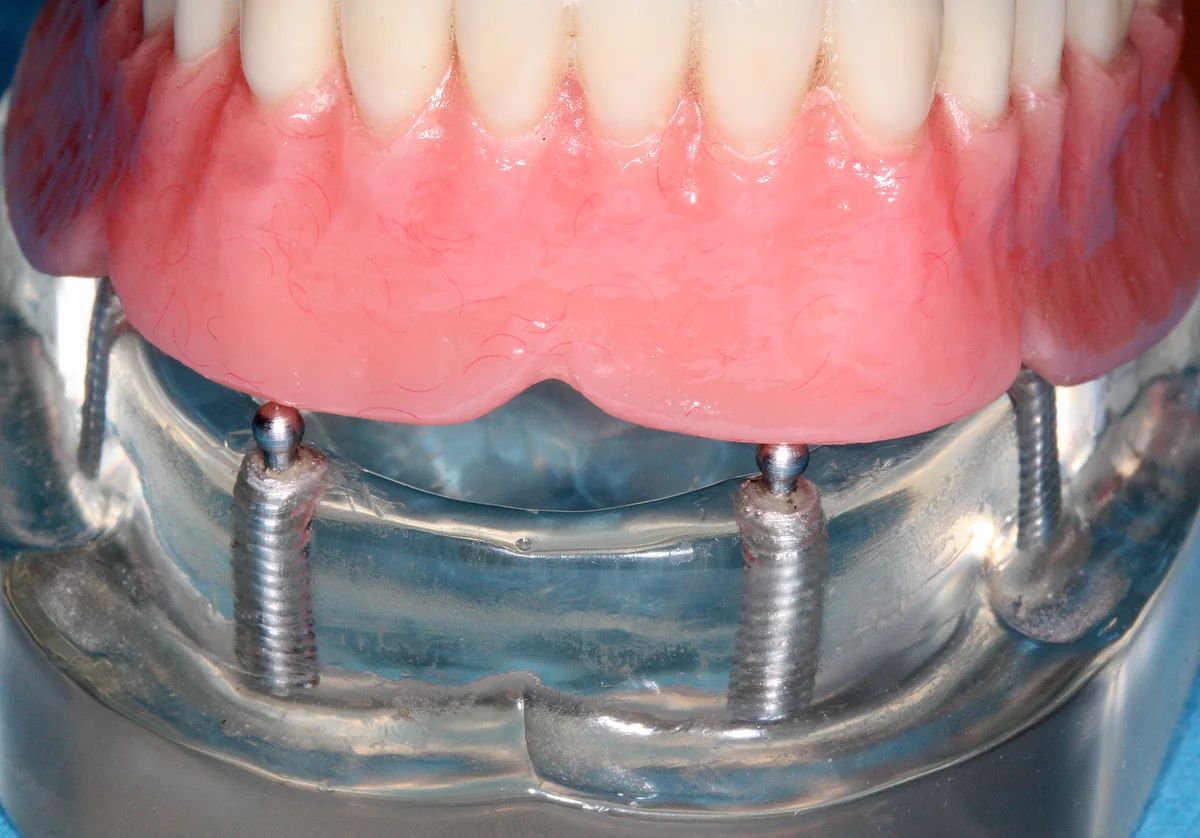 Demonstration model showing a lower denture above two ball-shaped implant attachments.
