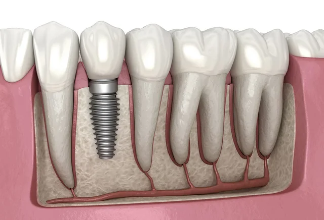 Cross-section illustration of a dental implant and crown beside natural teeth.